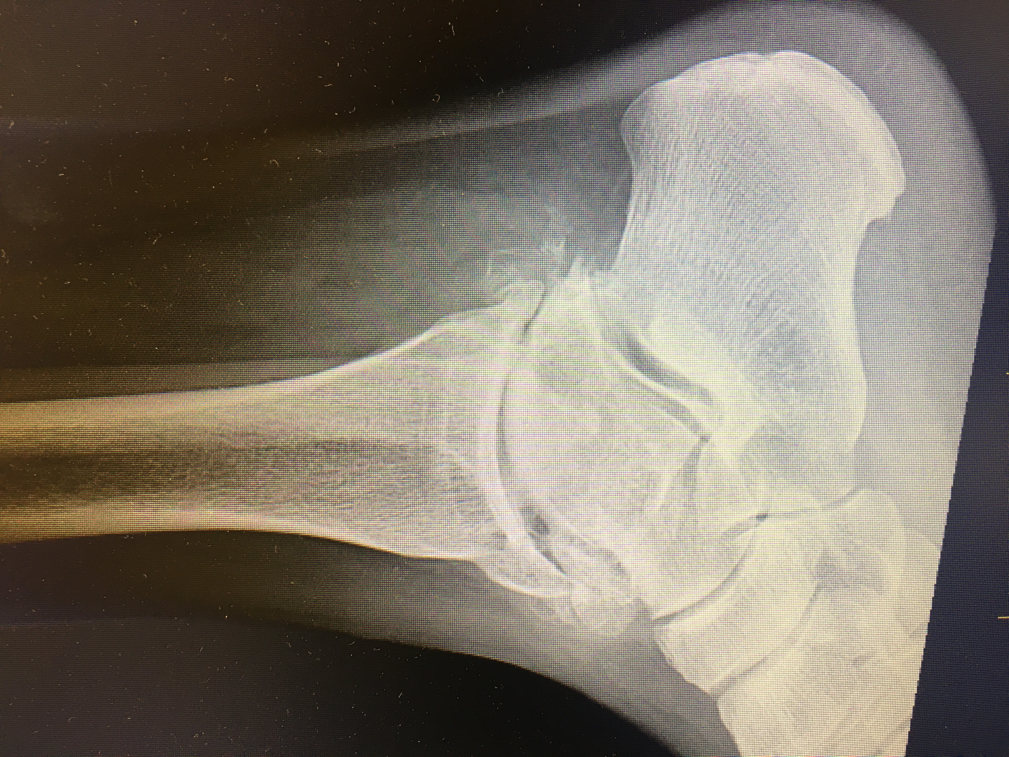 osteoarthritis ankle